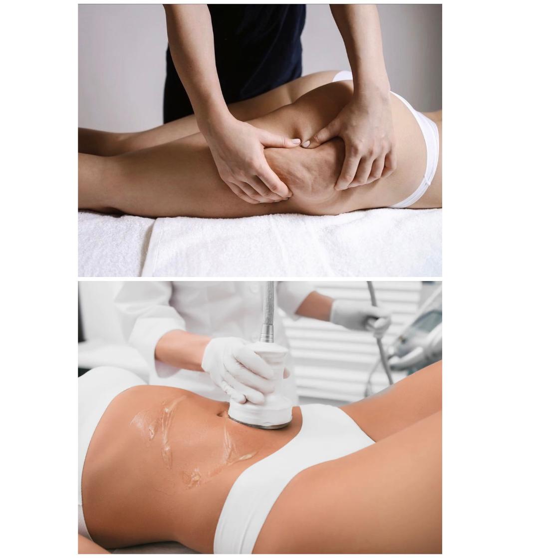 Forfait 5 séances lipocavitation + 5 séances de palper rouler 1h