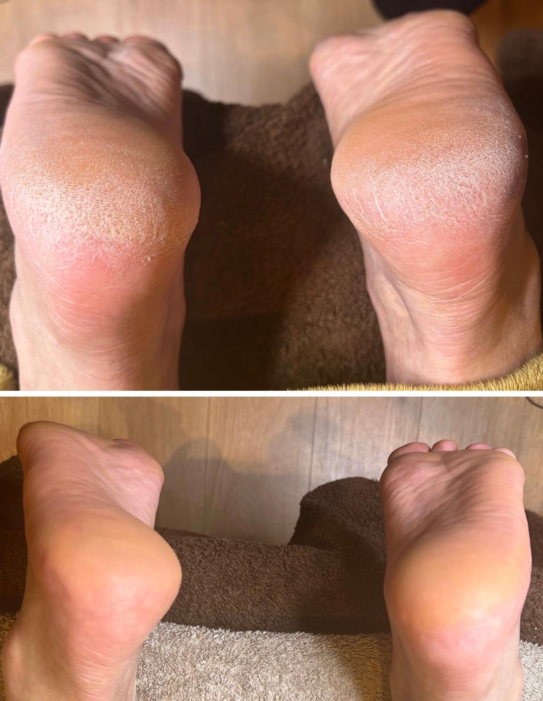 CALLUSPEELING® (Soin anti callosités) 30min