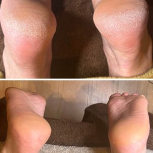 CALLUSPEELING® (Soin anti callosités) 30min
