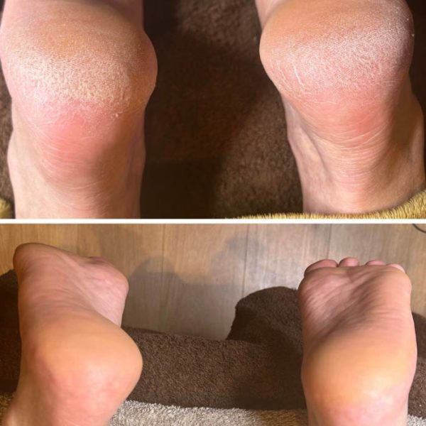 CALLUSPEELING® (Soin anti callosités) 30min